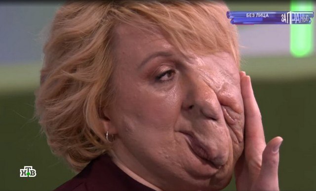 &laquo;Один сильный удар &ndash; и мгновенная смерть&raquo;: 38-летняя женщина живет с опухолью на лице и дыркой в гол