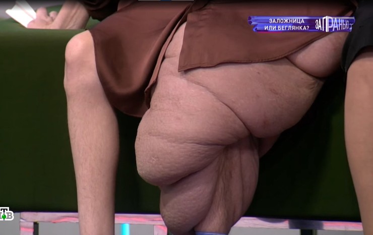 Нога увеличилась в три раза